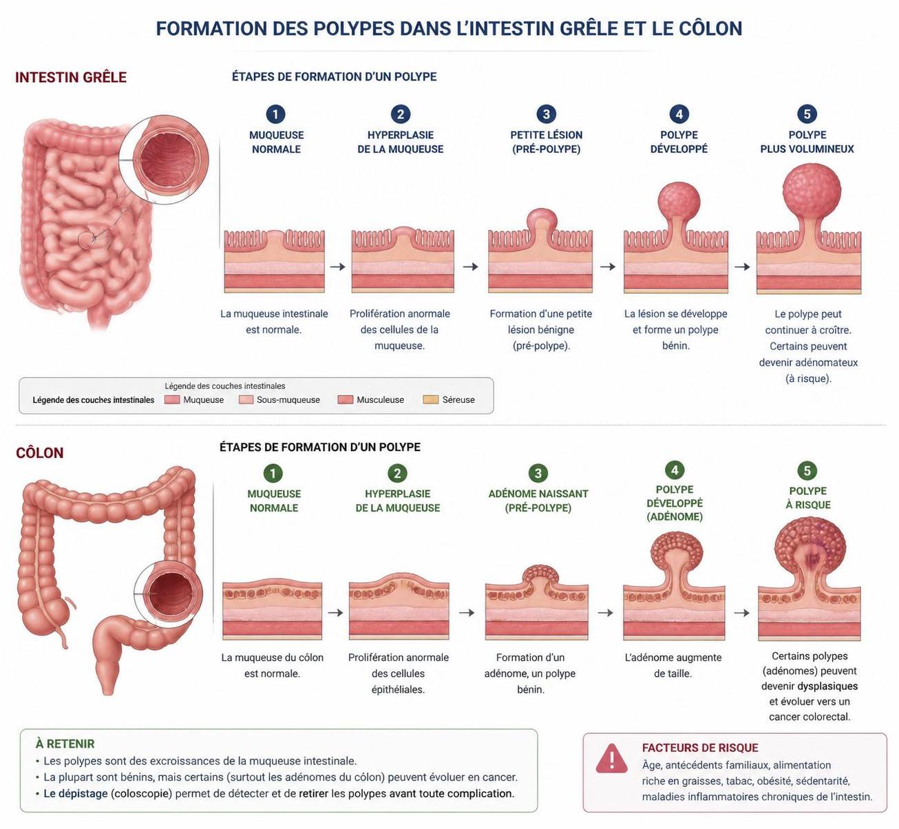 découvrez les symptômes de la polypose, une maladie souvent méconnue, pour mieux comprendre ses signes d’alerte et agir rapidement.