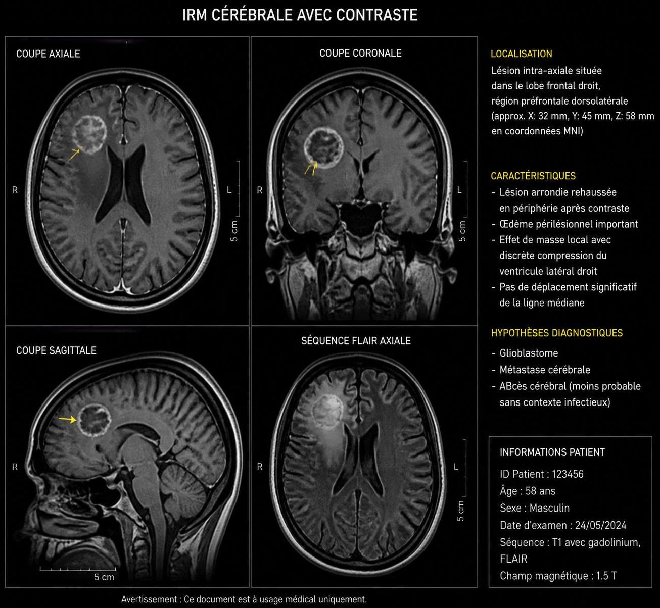 découvrez les symptômes clés d'une tumeur au cerveau et les signes d'alerte à ne pas ignorer pour une prise en charge rapide et efficace.