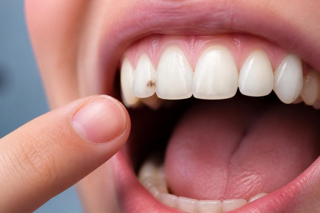 découvrez comment reconnaître les premiers symptômes de la carie dentaire pour agir rapidement et préserver la santé de vos dents avant que les dégâts ne s'aggravent.