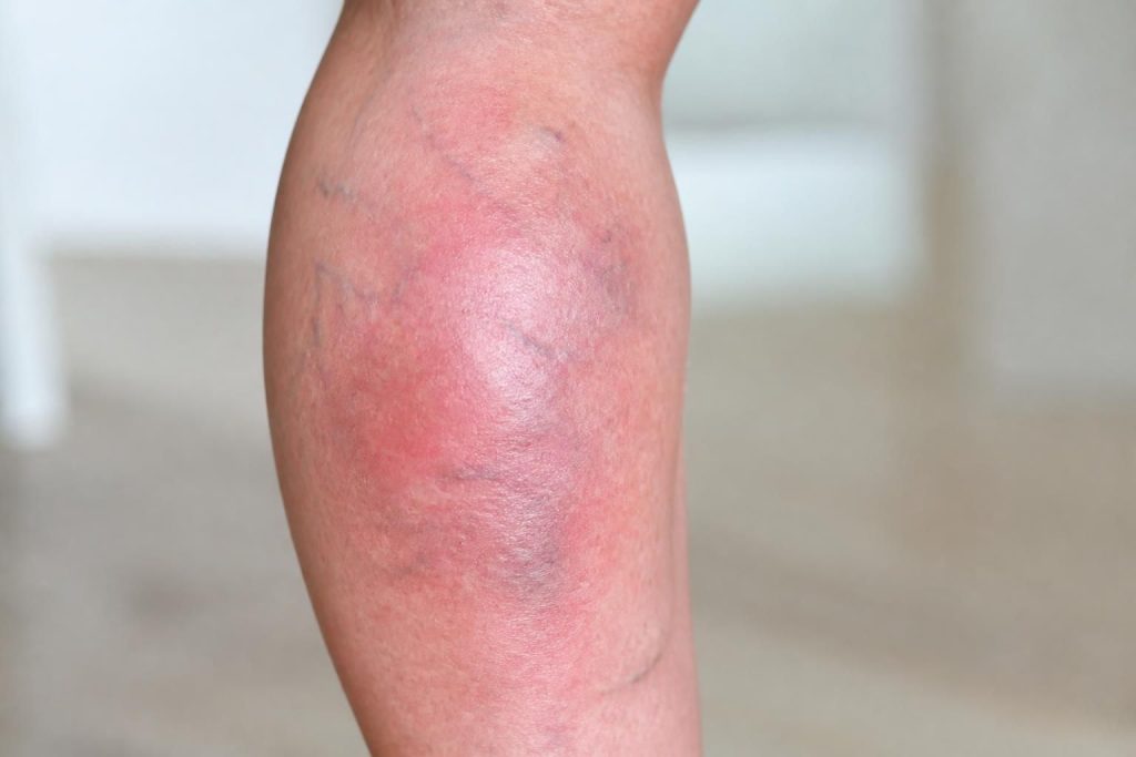 découvrez les symptômes de la phlébite à ne pas négliger pour agir rapidement et prévenir les complications graves.