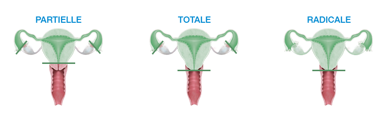 illustration hystérectomie d'action fibrome