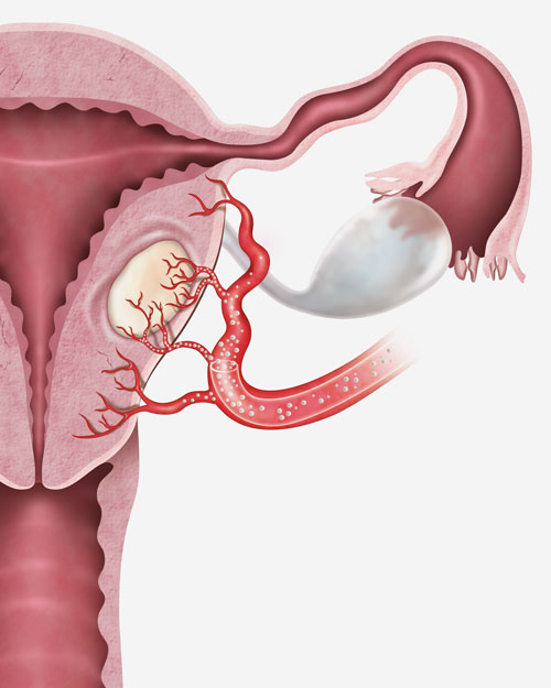 illustration embolisation d'action fibrome