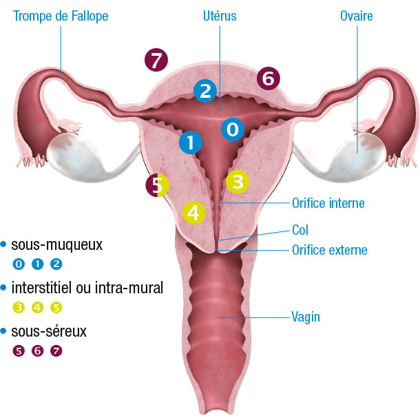 illustration fibromes par action fibrome