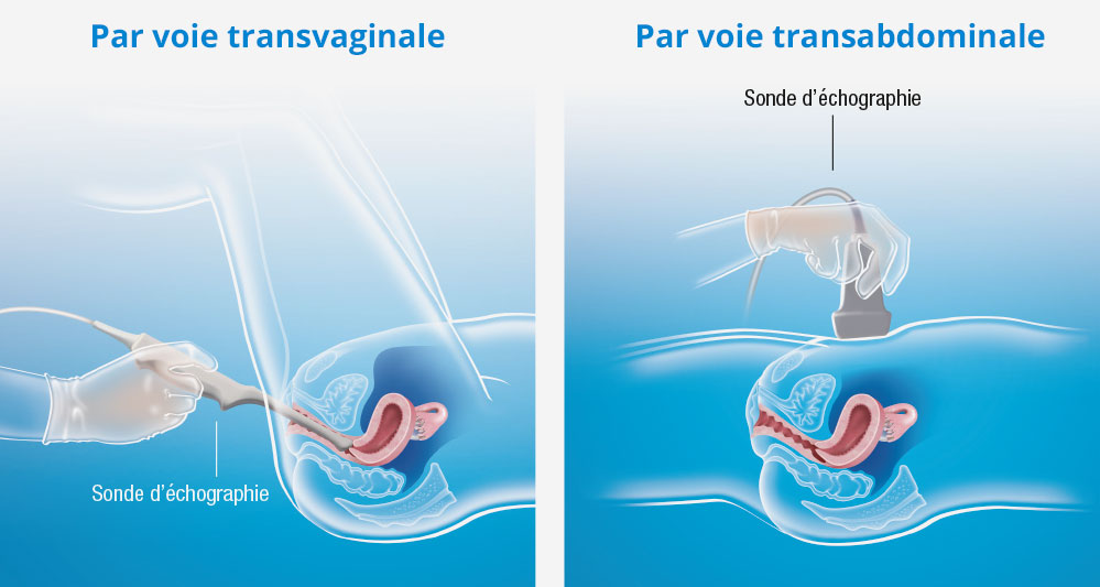 illustration échographie action fibrome