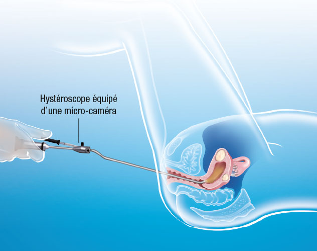 illustration hypersteroscopie avec micro caméra action fibrome