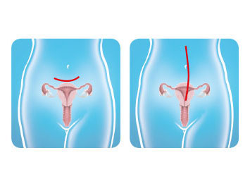 illustration abdominale action fibrome