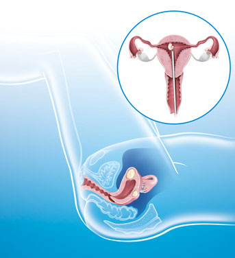 illustration vaginale action fibrome