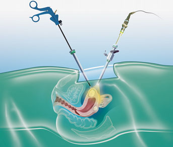 illustration abdominale action fibrome