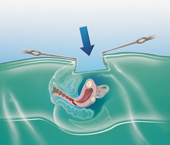 HD_N-laparotomie-abdominale